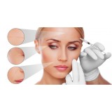 Alta Care Beauty Spa - Skin Microdermabrasion with Micro Crystals - Single Treatment